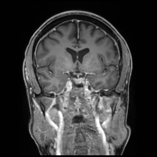 Cerebral abscess with ventriculitis (Radiopaedia 78965-91878 Coronal T1 C+ 28).jpg