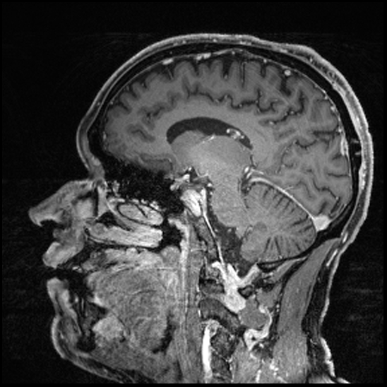 Cerebral abscess with ventriculitis (Radiopaedia 78965-91878 Sagittal T1 C+ 80).jpg