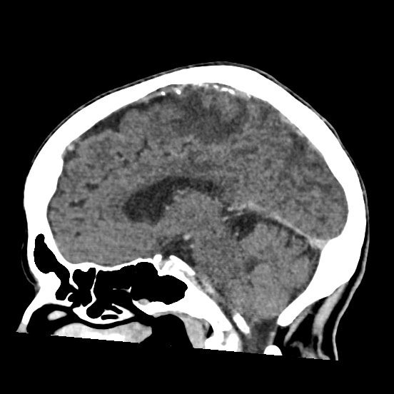 Cerebral amyloid angiopathy-related inflammation (Radiopaedia 74836-85848 C 28).jpg