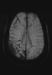 File:Cerebral amyloid angiopathy (Radiopaedia 29129-29518 Axial SWI MIP 22).jpg