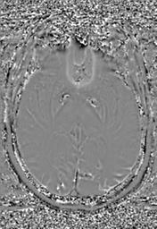 File:Cerebral amyloid angiopathy (Radiopaedia 29129-29518 Axial SWI Phase 17).jpg