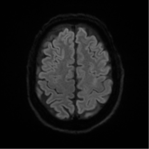 Cerebral amyloid angiopathy (Radiopaedia 46082-50433 Axial DWI 48).png