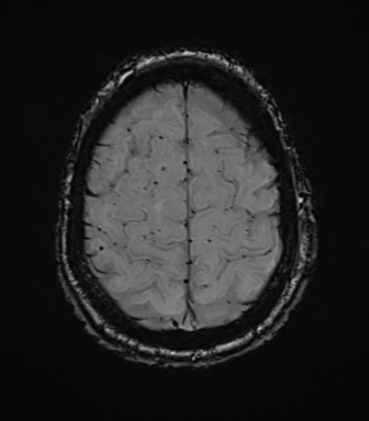 Cerebral amyloid angiopathy (Radiopaedia 46082-50433 Axial SWI 71).png