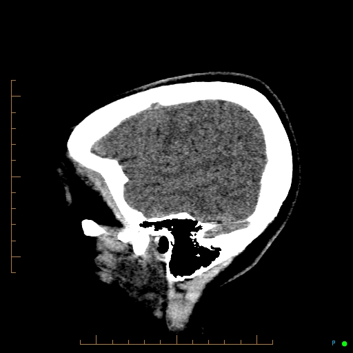 Cerebral arteriovenous malformation (AVM) (Radiopaedia 78162-90706 A 13).jpg