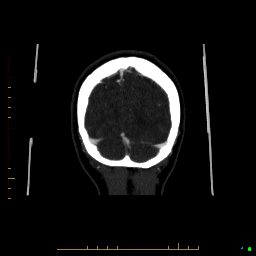 Cerebral arteriovenous malformation (AVM) (Radiopaedia 78162-90706 Coronal CTA 16).jpg