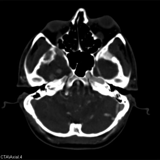 Cerebral arteriovenous malformation (Radiopaedia 28518-28759 B 4).jpg