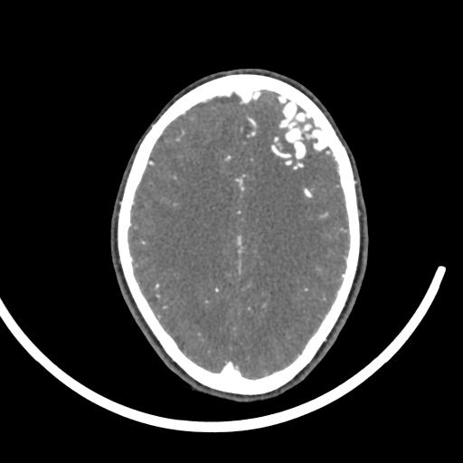 Cerebral arteriovenous malformation (Radiopaedia 29531-30031 E 79).jpg