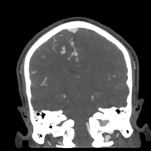 Cerebral arteriovenous malformation (Radiopaedia 39259-41505 E 38).png