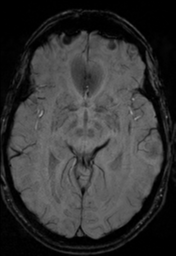 File:Cerebral arteriovenous malformation (Radiopaedia 55798-62372 Axial SWI 18).png