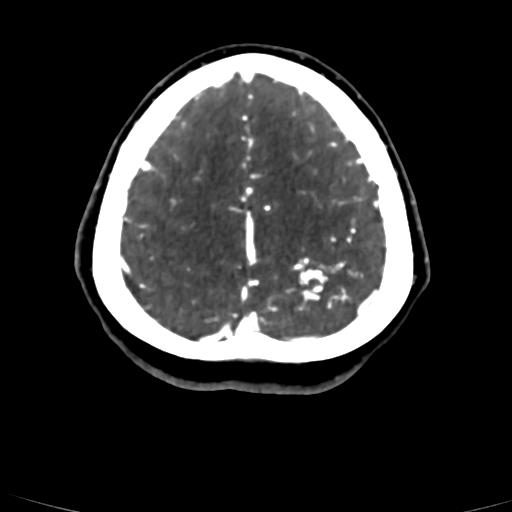 Cerebral arteriovenous malformation (Radiopaedia 73830-84645 Axial C+ delayed 14).jpg