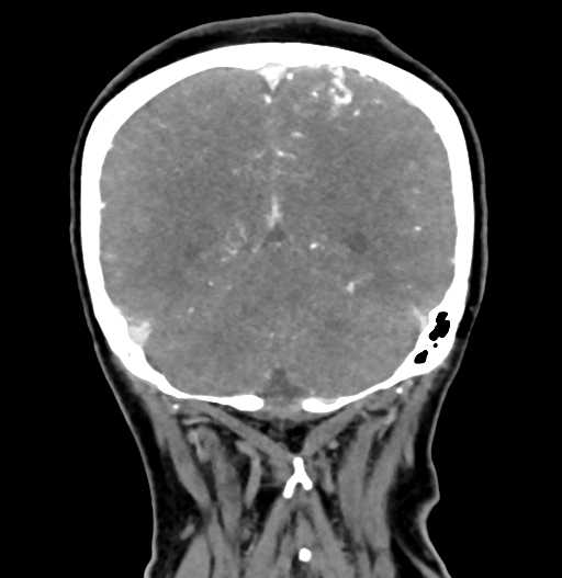 Cerebral arteriovenous malformation (Radiopaedia 73830-84645 C 74).jpg