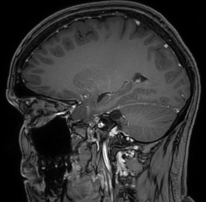 Cerebral arteriovenous malformation (Radiopaedia 74411-85654 Sagittal T1 C+ 45).jpg