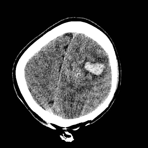 Cerebral arteriovenous malformation (Radiopaedia 79677-92887 Axial non-contrast 39).jpg