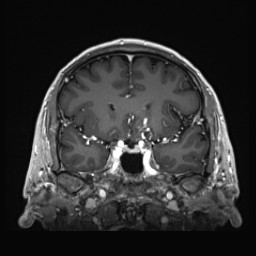 Cerebral arteriovenous malformation (Radiopaedia 84015-99245 Coronal T1 C+ 61).jpg