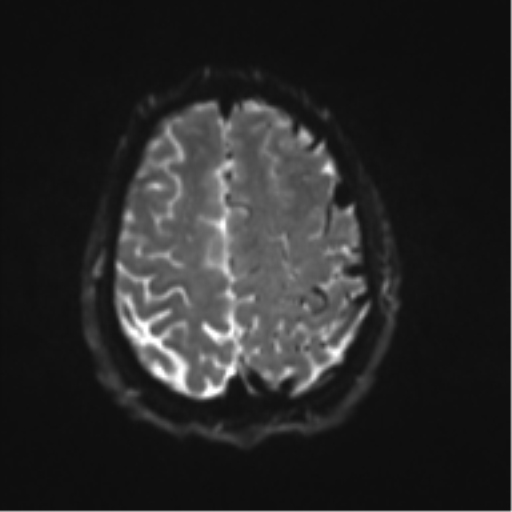 File:Cerebral arteriovenous malformation - huge (Radiopaedia 35734-37272 Axial DWI 19).png