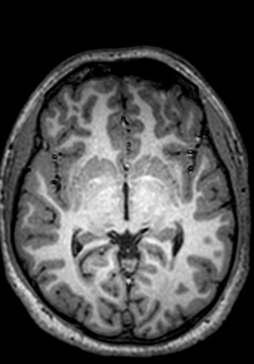 Cerebral arteriovenous malformation at posterior body of corpus callosum (Radiopaedia 74111-84925 Axial T1 162).jpg