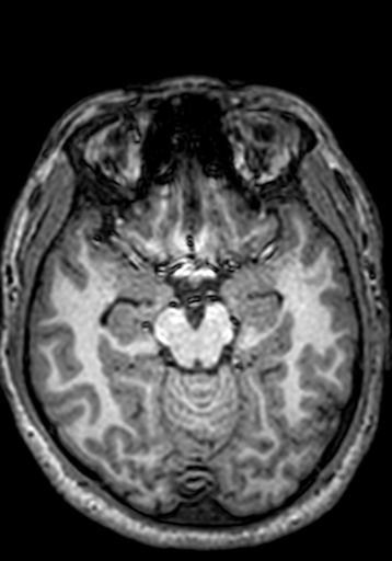 Cerebral arteriovenous malformation at posterior body of corpus callosum (Radiopaedia 74111-84925 Axial T1 191).jpg