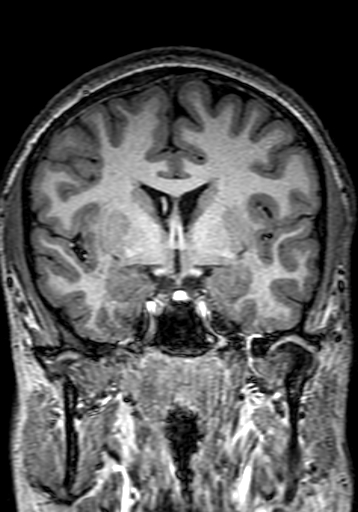 Cerebral arteriovenous malformation at posterior body of corpus callosum (Radiopaedia 74111-84925 Coronal T1 139).jpg