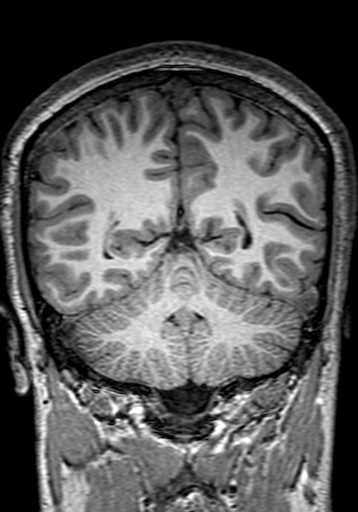 File:Cerebral arteriovenous malformation at posterior body of corpus callosum (Radiopaedia 74111-84925 Coronal T1 246).jpg