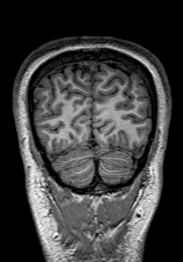 Cerebral arteriovenous malformation at posterior body of corpus callosum (Radiopaedia 74111-84925 Coronal T1 308).jpg