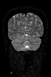 Cerebral arteriovenous malformation at posterior body of corpus callosum (Radiopaedia 74111-84925 Coronal T2 148).jpg