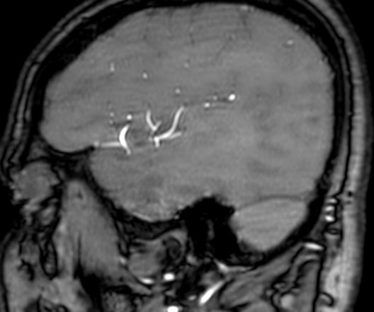 Cerebral arteriovenous malformation at posterior body of corpus callosum (Radiopaedia 74111-84925 J 62).jpg