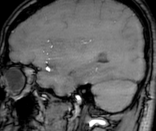 Cerebral arteriovenous malformation at posterior body of corpus callosum (Radiopaedia 74111-84925 J 95).jpg