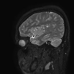 Cerebral arteriovenous malformation at posterior body of corpus callosum (Radiopaedia 74111-84925 Sagittal T2 107).jpg