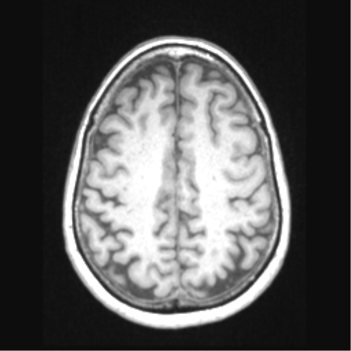 Cerebral arteriovenous malformation with hemorrhage (Radiopaedia 34422-35737 Axial T1 56).png