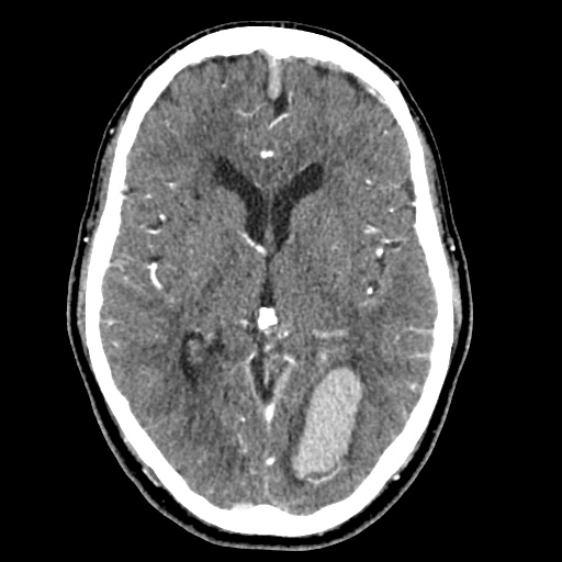 Cerebral arteriovenous malformation with lobar hemorrhage (Radiopaedia 35598-57216 A 30).jpg