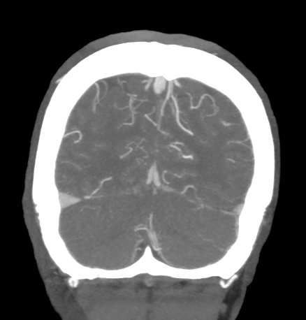 Cerebral arteriovenous malformation with lobar hemorrhage (Radiopaedia 44725-48511 B 48).png