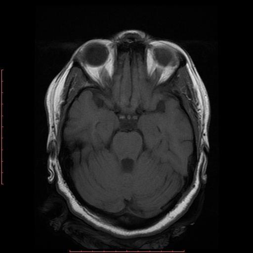 File:Cerebral cavernous malformation (Radiopaedia 26177-26306 Axial T1 8).jpg