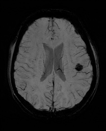 Cerebral cavernous venous malformation (Radiopaedia 70008-80021 Axial SWI 44).jpg