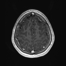 Cerebral cavernous venous malformation (Radiopaedia 70008-80021 Axial T1 C+ 82).jpg