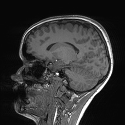 File:Cerebral cavernous venous malformation (Radiopaedia 70008-80021 Sagittal T1 45).jpg
