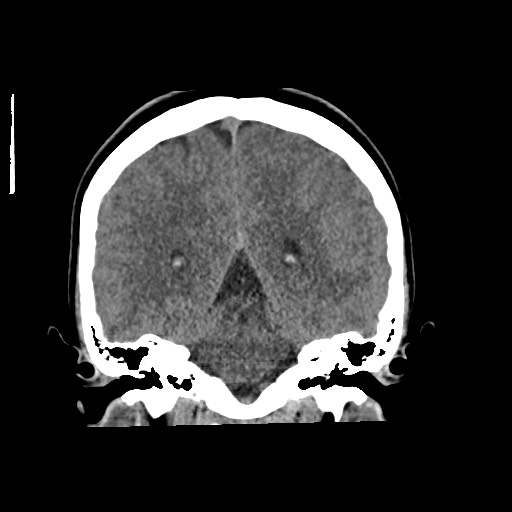 Cerebral cavernous venous malformation (Radiopaedia 70008-80022 non-contrast 46).jpg
