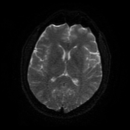 Cerebral cavernous venous malformation (Zabramski type II) (Radiopaedia 85511-101198 Axial DWI 84).jpg