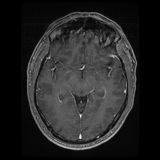 Cerebral cavernous venous malformation (Zabramski type II) (Radiopaedia 85511-101198 Axial T1 C+ fat sat 49).jpg