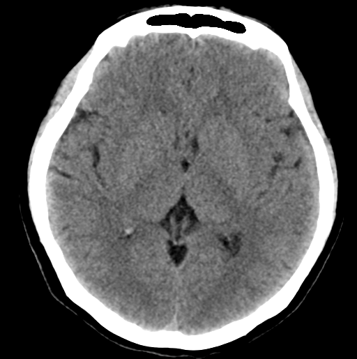 File:Cerebral cavernous venous malformations (Radiopaedia 48117-52945 Axial non-contrast 17).png