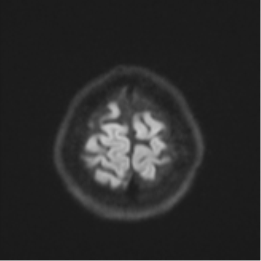 Cerebral cavernous venous malformations (Radiopaedia 48117-52946 Axial DWI 53).png