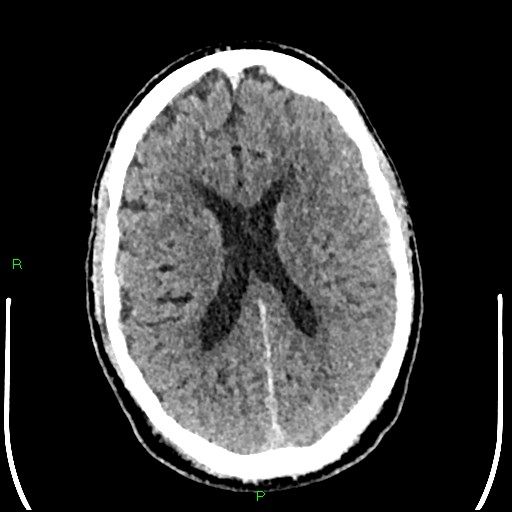 Cerebral contusions (Radiopaedia 33868-35039 Axial non-contrast 128).jpg