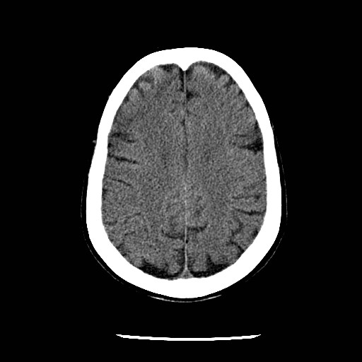 Cerebral edema (evolution in time) (Radiopaedia 19418-19441 non-contrast 68).jpg