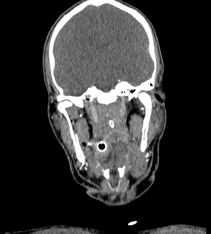 Cerebral edema in an overdose patient (Radiopaedia 72005-82539 B 43).jpg