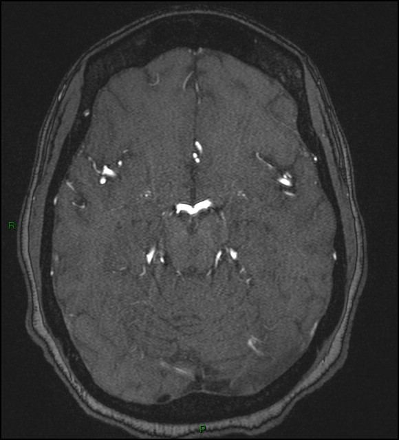 Cerebral fat embolism (Radiopaedia 35022-36525 Axial TOF 81).jpg