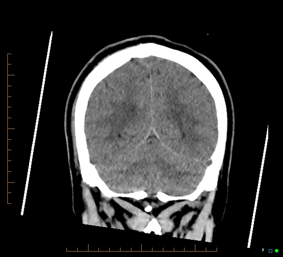 Cerebral fat embolism (Radiopaedia 85521-101220 Coronal non-contrast 47).jpg