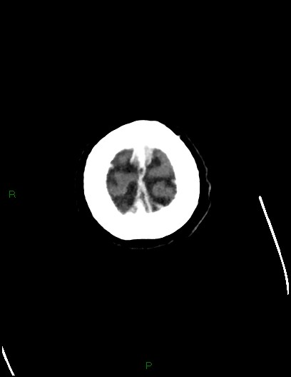 Cerebral metastases - ependymal and parenchymal (Radiopaedia 79877-93131 Axial C+ delayed 82).jpg