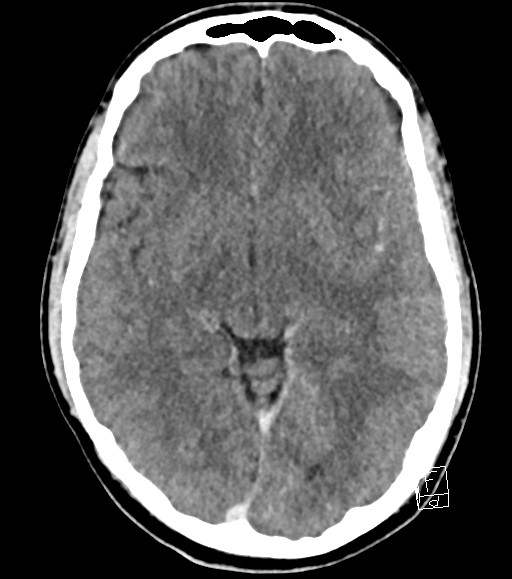 Cerebral metastases - testicular choriocarcinoma (Radiopaedia 84486-99855 Axial C+ delayed 32).jpg