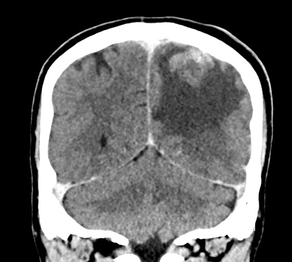 Cerebral metastases - testicular choriocarcinoma (Radiopaedia 84486-99855 D 46).jpg