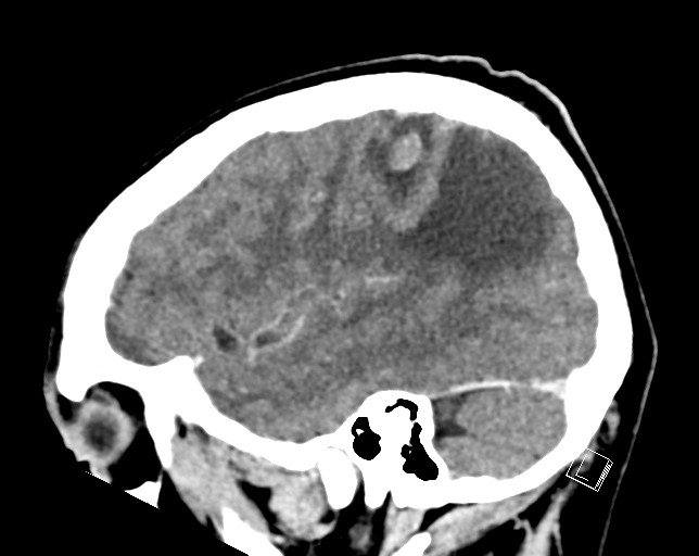 Cerebral metastases - testicular choriocarcinoma (Radiopaedia 84486-99855 F 16).jpg