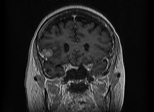Cerebral metastases from lung cancer with amyloid angiopathy and cerebellopontine angle meningioma (Radiopaedia 74306-85191 Coronal T1 C+ 18).jpg